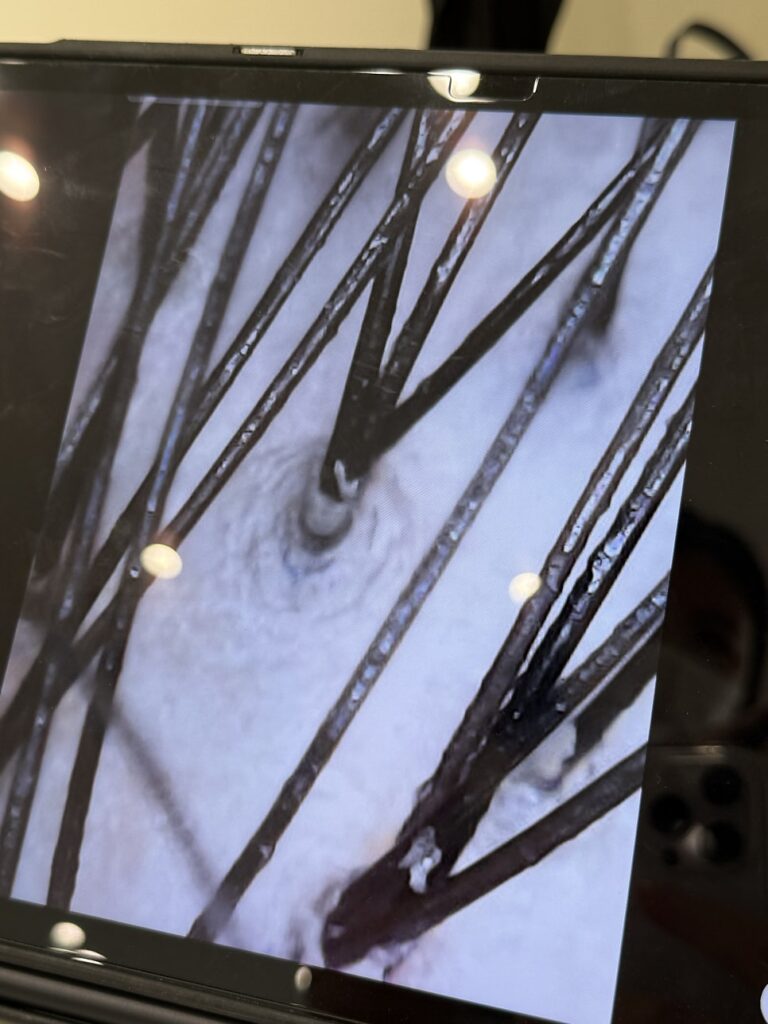 Magnified scalp scan showing oil and flakes around the pores
